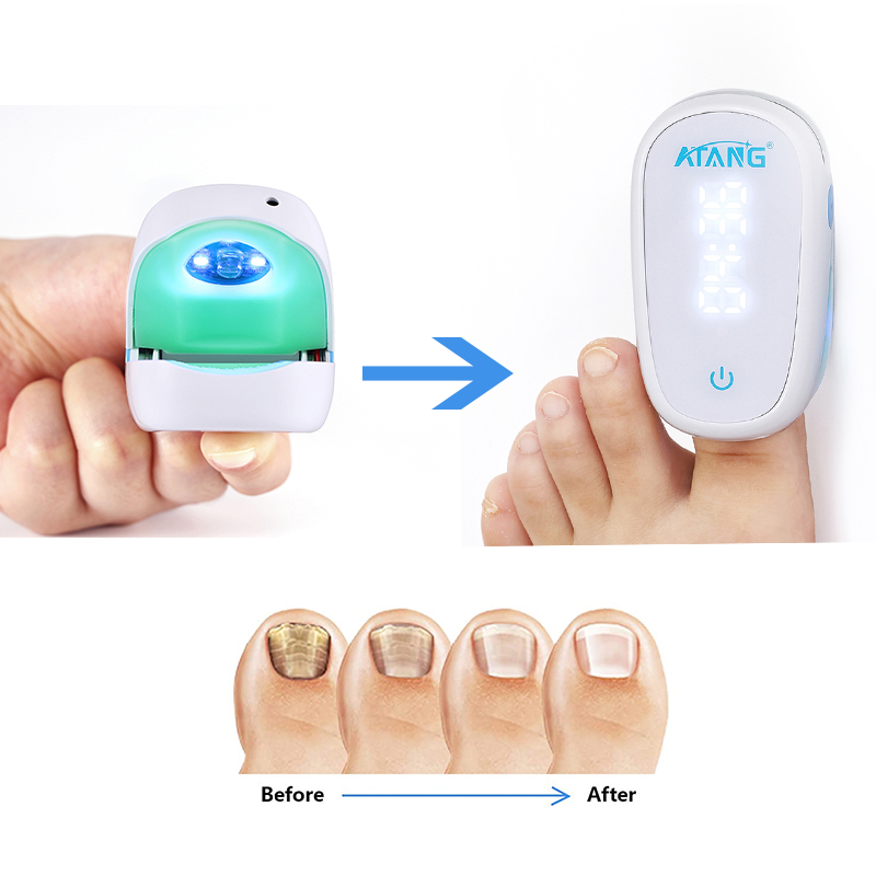 Laser Nail Fungus