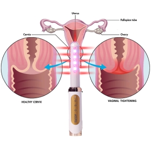 Laser Vaginal Tightening Rejuvenation Women Health Care Product Vagina Rehabilitation Cold Laser Therapy
