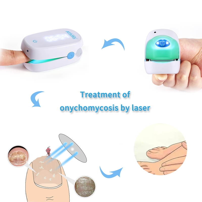 Painless Nail Fungus Cold Laser Treatment Device Nail Fungus Removal Foot Care Nail Cleaning Device No Side Effects Safety Onychomycosis Infrared Light Nail Laser